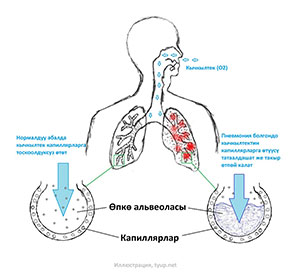 Пневмония, иллюстрация